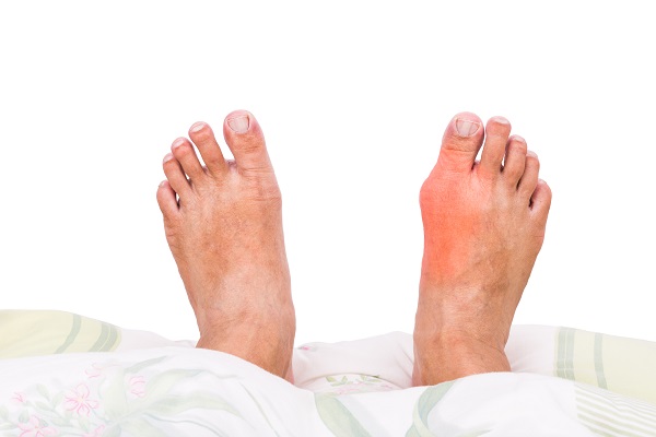 foot affected by gout