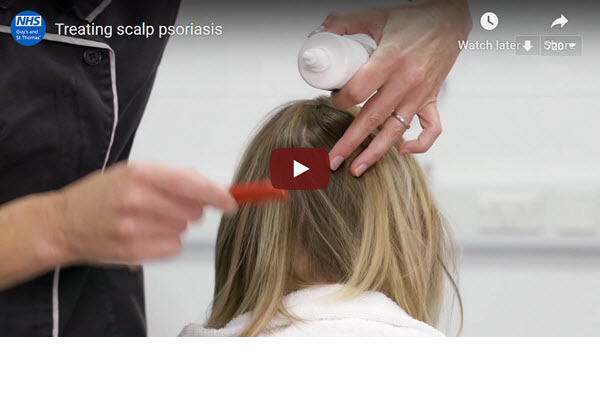 treating scalp psoriasis